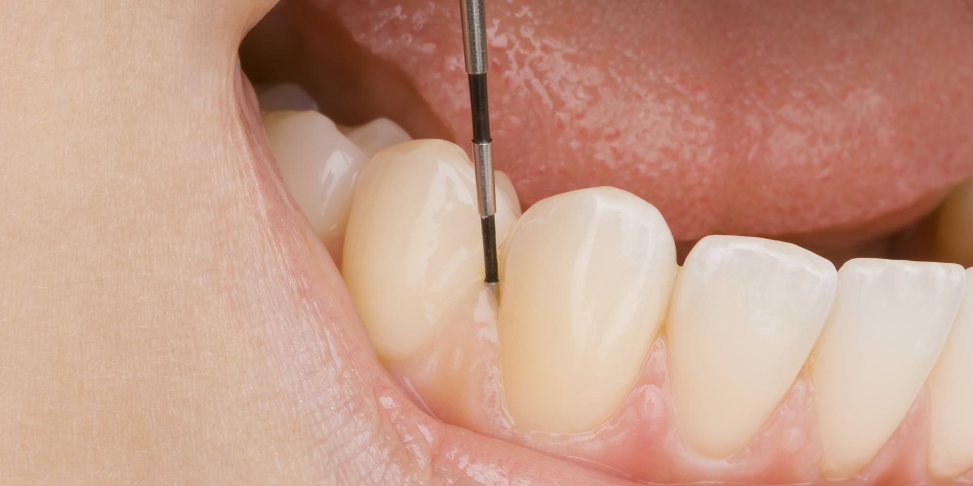 parodontitis, parodontose, zahnlockerung, zahnfleischentzündung